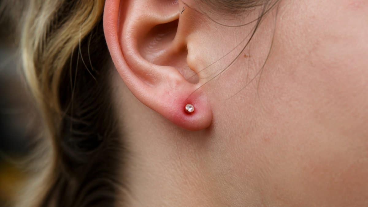Close-up of an earlobe showing redness and mild inflammation around a fresh piercing site with jewelry visible